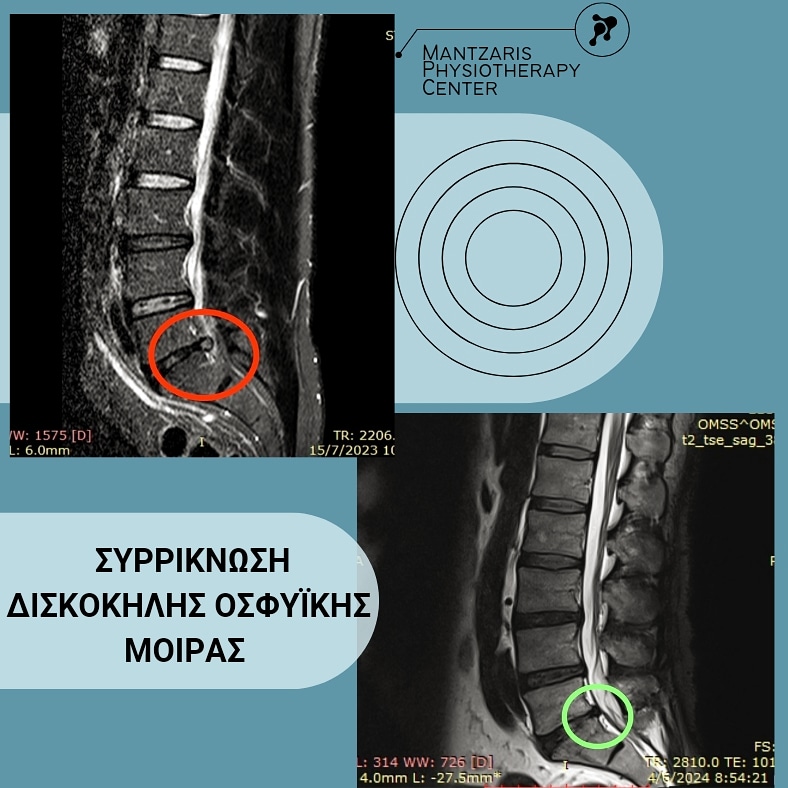 Συρρίκνωση οσφυικής δισκοκήλης μέσης σε ανδρα 46 ετών