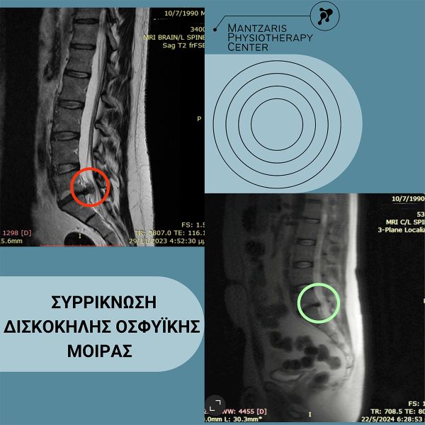 Συρρίκνωση αυχενικής δισκοκήλης αυχένα ανδρα 51 ετών