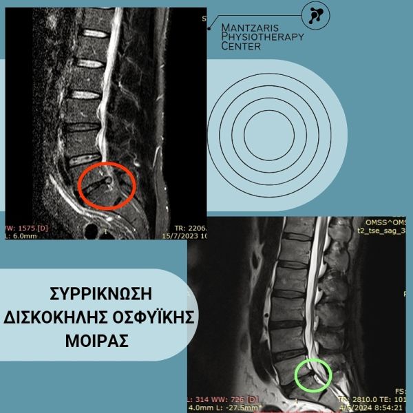 Συρρίκνωση οσφυικής δισκοκήλης μέσης σε ανδρα 46 ετών