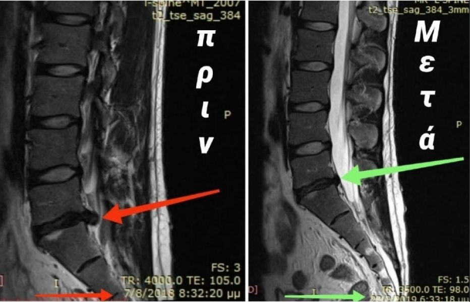 Συρρίκνωση οσφυϊκής δισκοκήλης (10 καινοτόμες  συνεδρίες φυσικοθεραπείας)