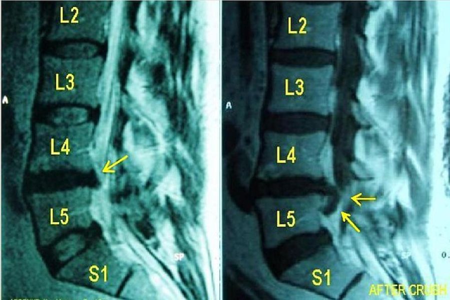 Αποφυγή Χειρουργείου Δισκοκήλης Αυχένα - Μέσης Σπονδυλικής στήλης