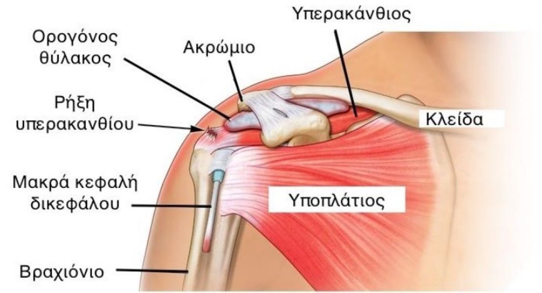 Πρόσκρουση ώμου και Φυσικοθεραπεία